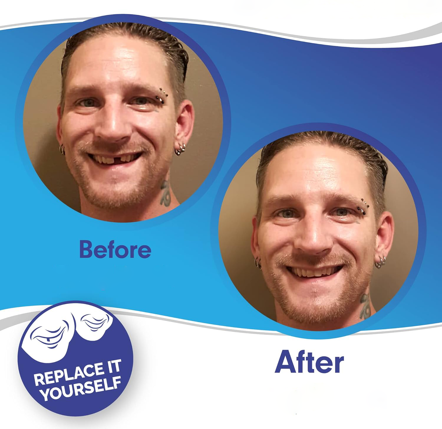 03 Smile Veneer (Upper & Lower Included)
