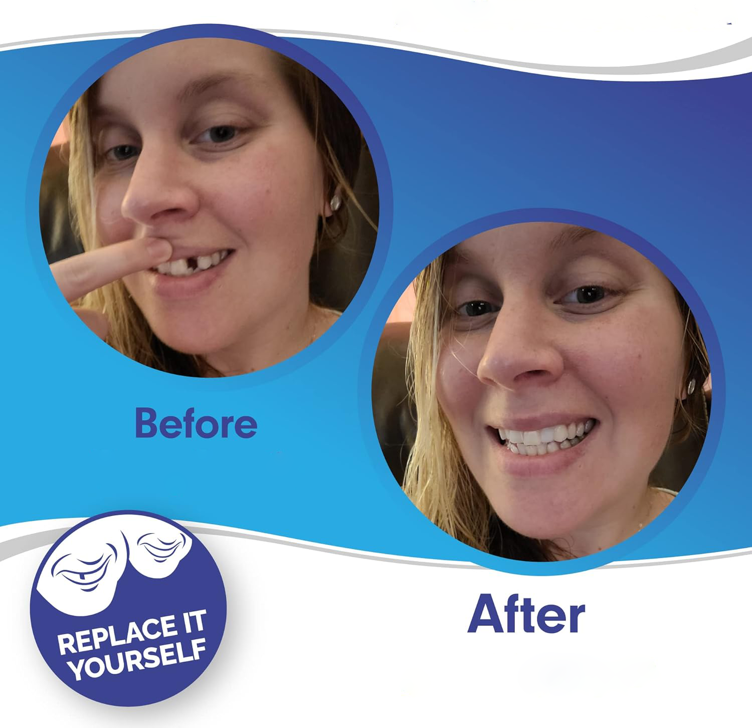 03 Smile Veneer (Upper & Lower Included)