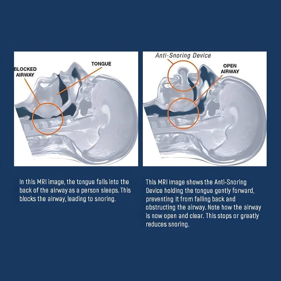 Sleep Apnea Tongue Retainer, Non-Invasive Snoring Relief Aid