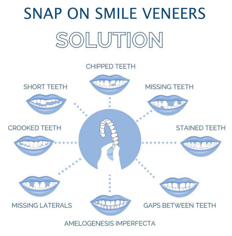 03 Smile Veneer (Upper & Lower Included)